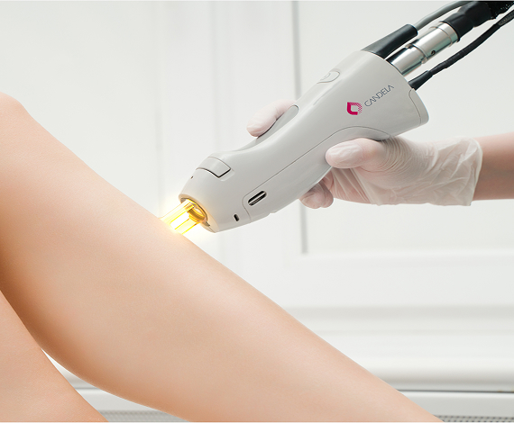 Laser procedures